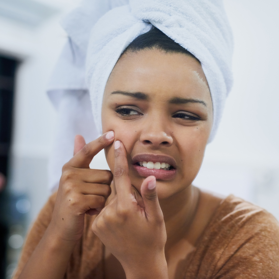 ACNE HACKS AND TIPS